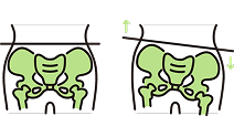 骨盤の歪みのイラスト